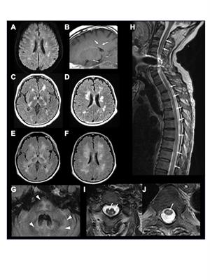 Case report: Atypical case of autoimmune glial fibrillary acidic protein astrocytopathy following COVID-19 vaccination refractory to immunosuppressive treatments